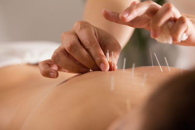 The doctor sticks needles into thegirl's body on the acupuncture, close-up view
